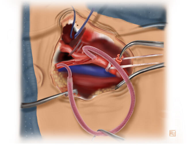 Surgical Step Procedure In-Progress Illustration